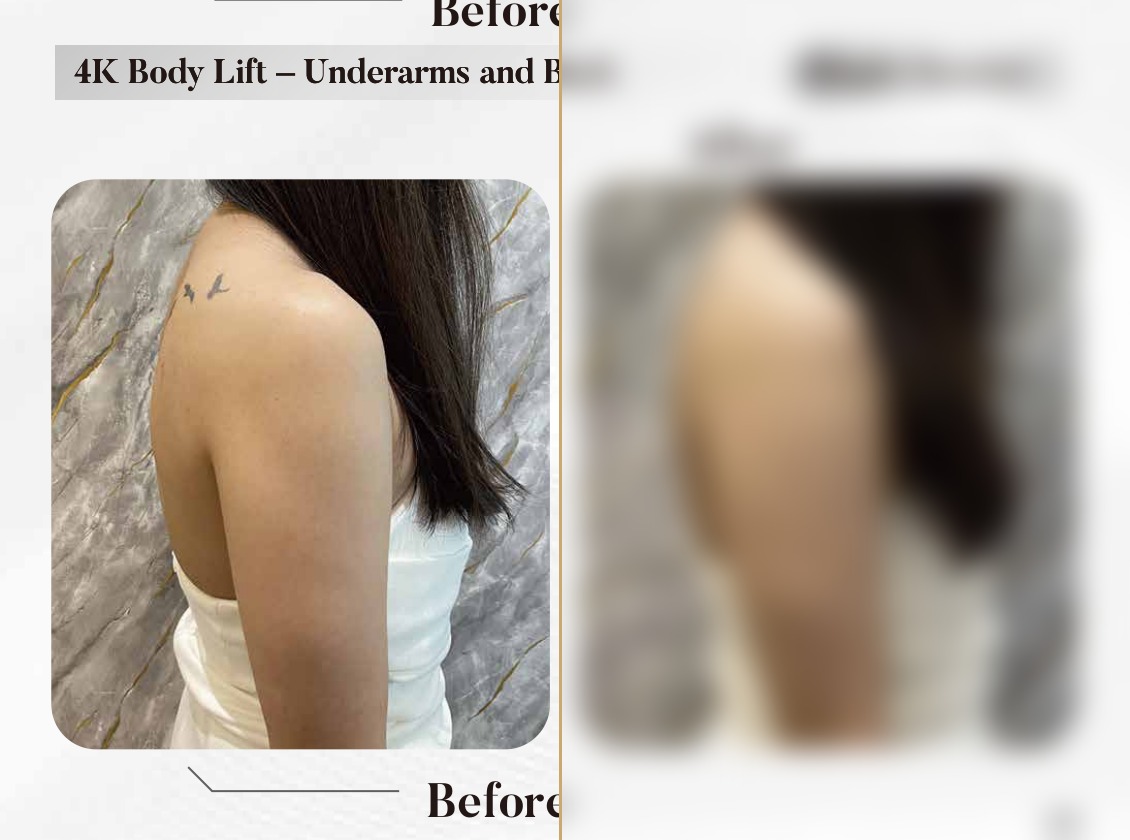 4K Body Lift — Underarms & Back (Single Session)