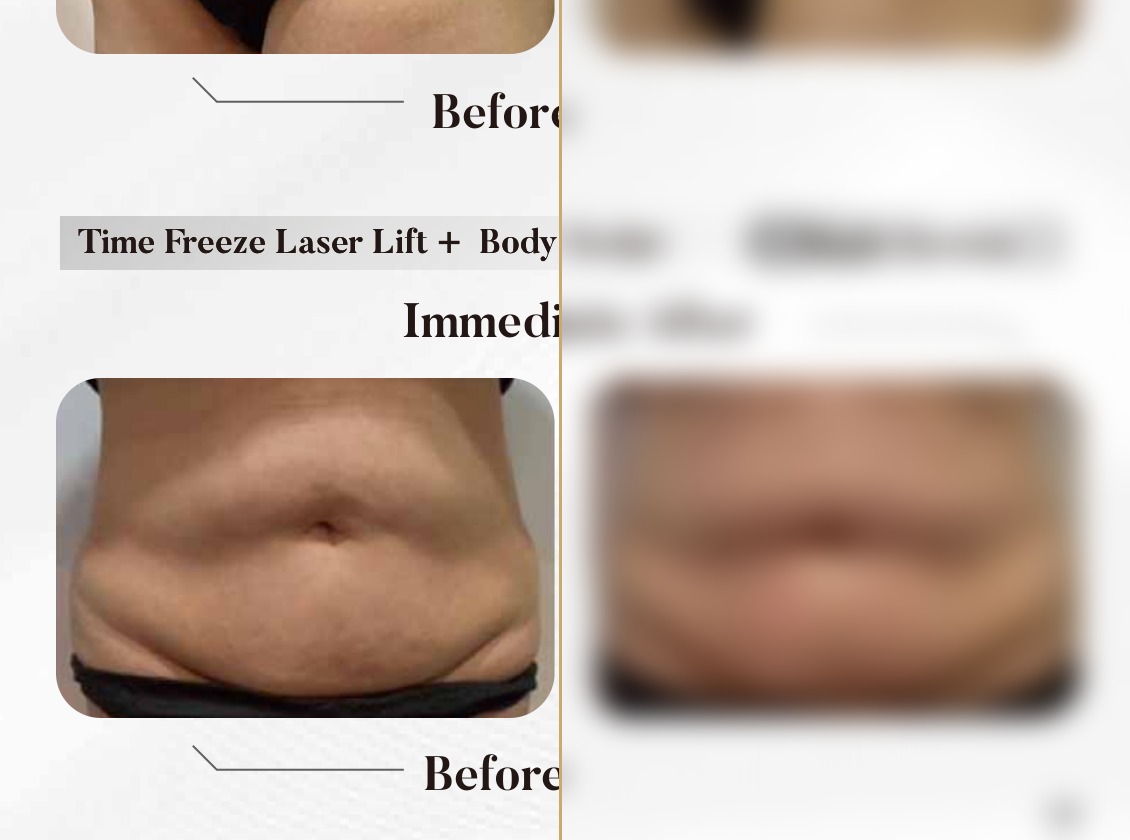 Time Freeze Laser Lift + Body Sculpt — Immediately After (Single Session)