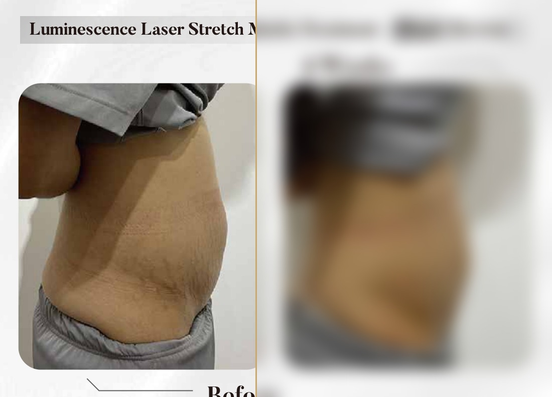 Luminescence Laser — Stretch Marks Treatment, 4 Weeks (Single Session)