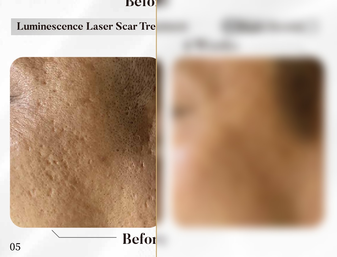 Luminescence Laser — Scar Treatment, 4 Weeks (Single Session)