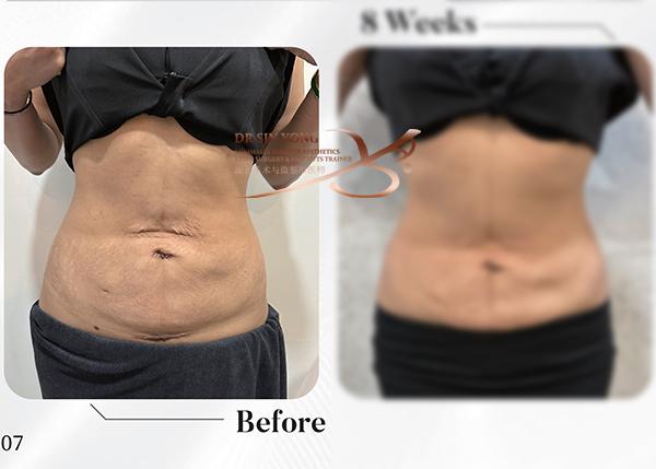 Luminescence Tummy Loose Skin Lift