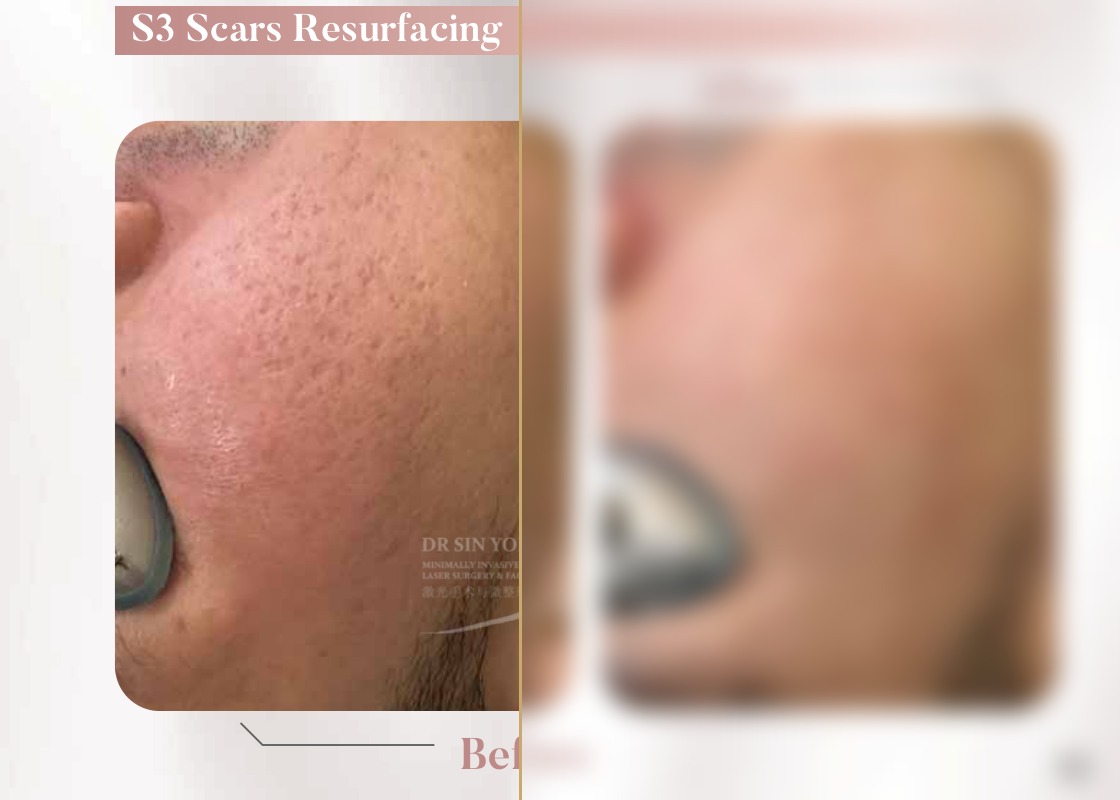 S3 Resurfacing Lift Laser — Scars Resurfacing