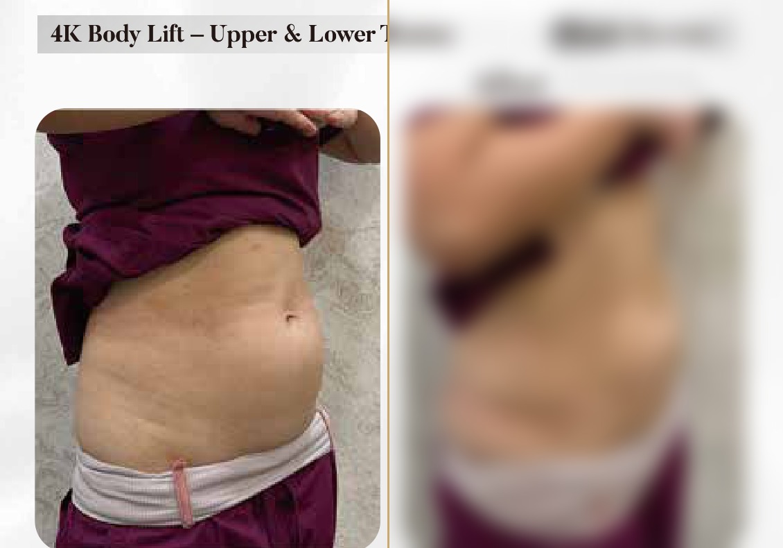 4K Body Lift — Upper & Lower Tummy Side Profile (Single Session)