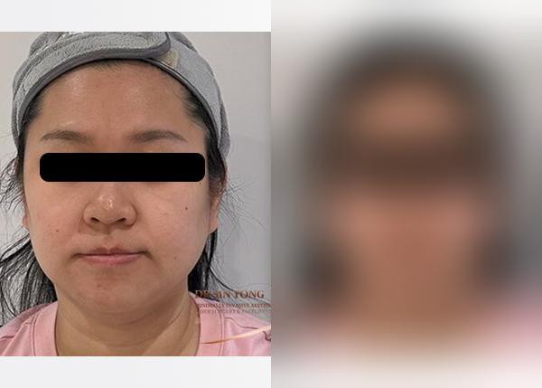 VF Lift — Vertical Facelift