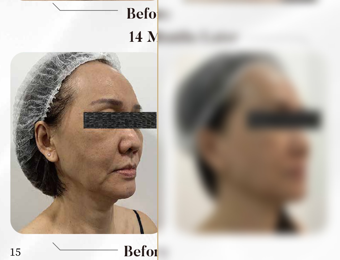 Time Freeze Laser Lift — 14 Months Later, Profile (Single Session)