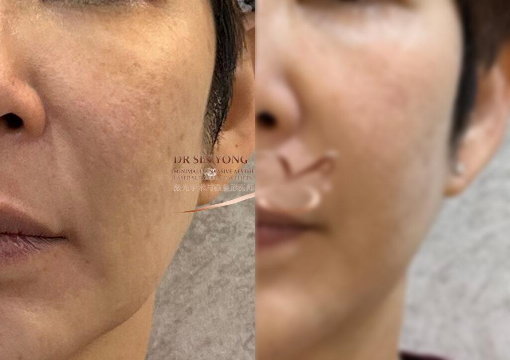 FSX Flawless Smooth Laser — Pores & Melasma