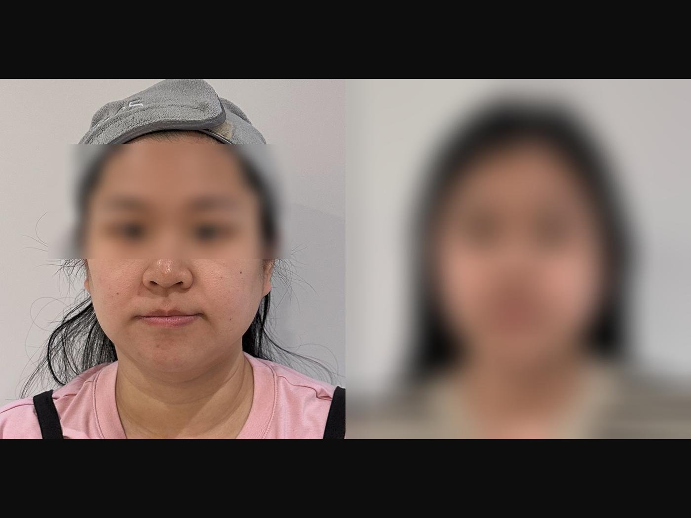 VF Facelift - Sculpts Excess Lower Face Volume