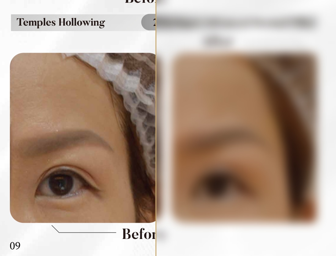 Dermal Filler — Temples Hollowing (2 Syringes)