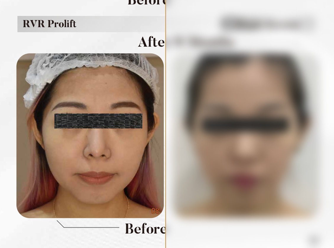 RVR ProLift — After 9 Months (Single Session)