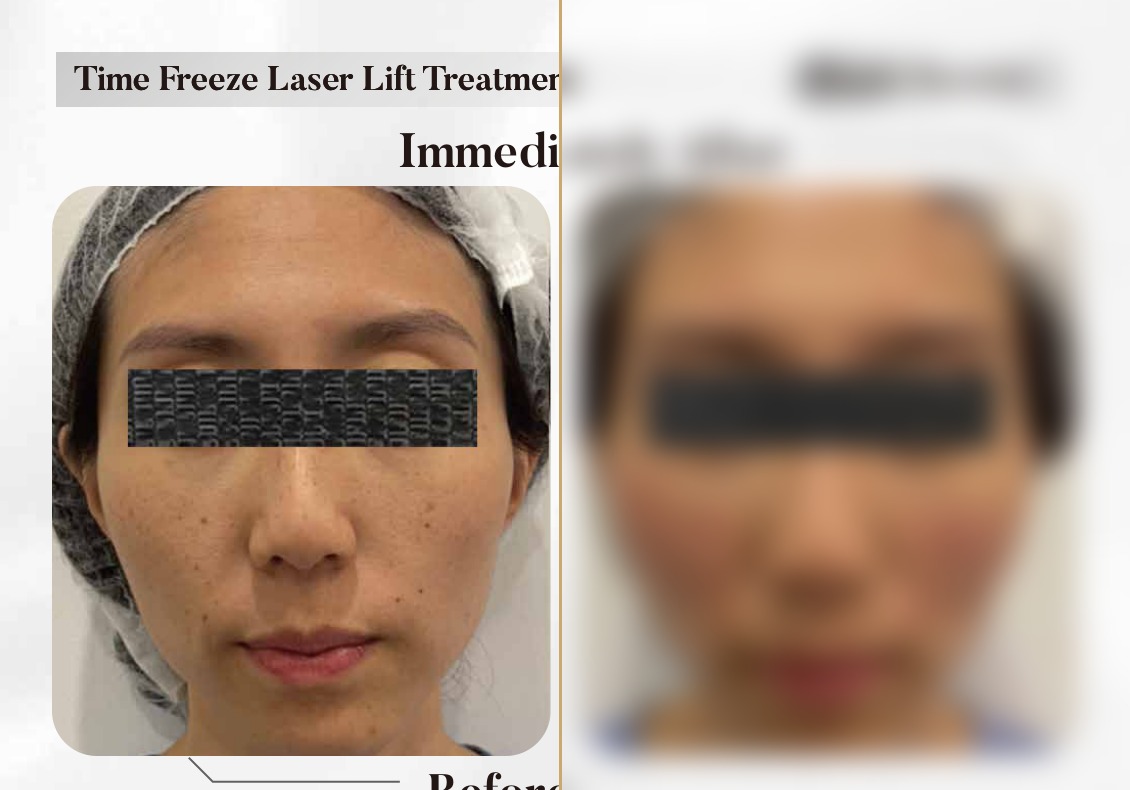 Time Freeze Laser Lift — Immediately After, Frontal (Single Session)