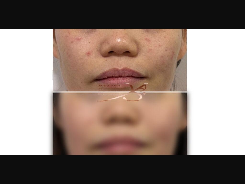 FSX Flawless Smooth Laser — 48hrs Later — Acne Treatment