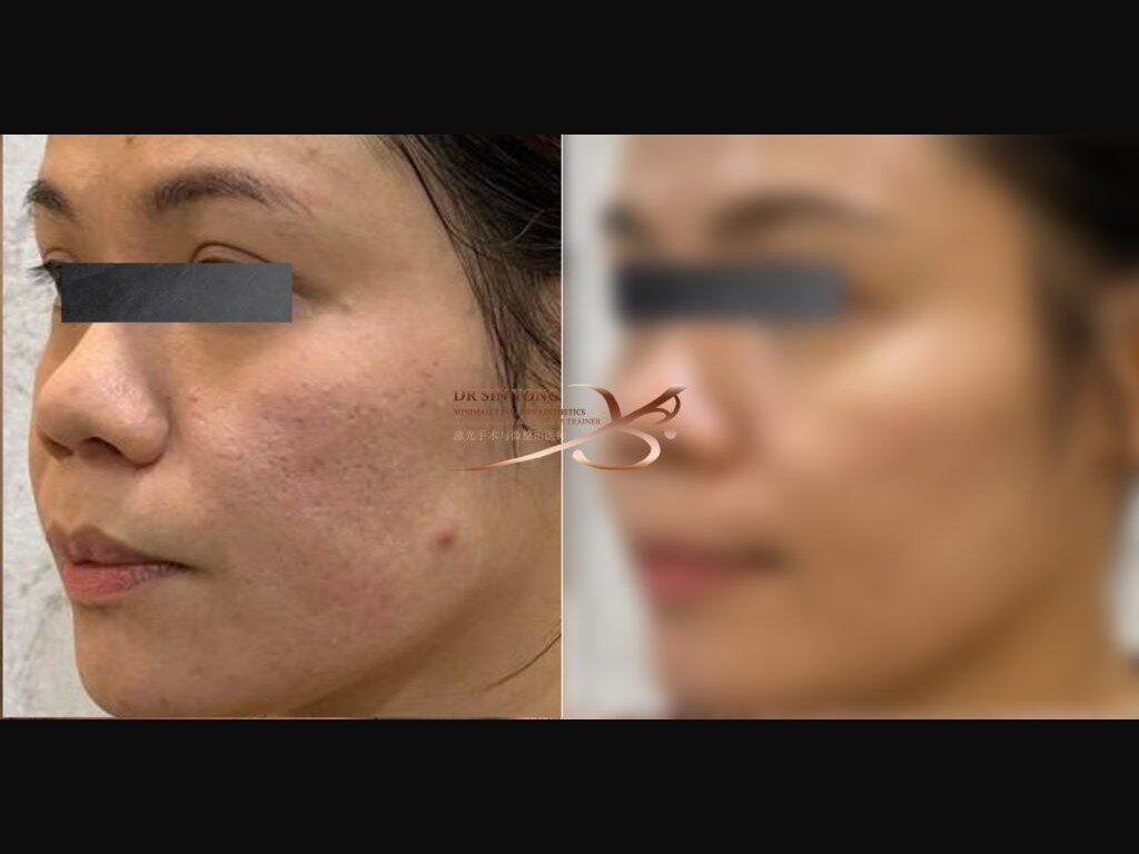 Tetra Pro Scar3 — Acne Scar Treatment (Boxcar, Icepick, Rolling Scars)