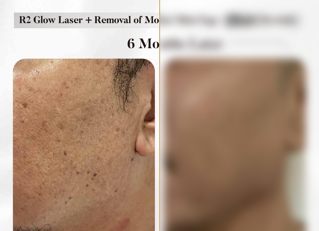 R2 Glow Laser + Mole/Skin Tag Removal — 6 Months Later (Single Session)