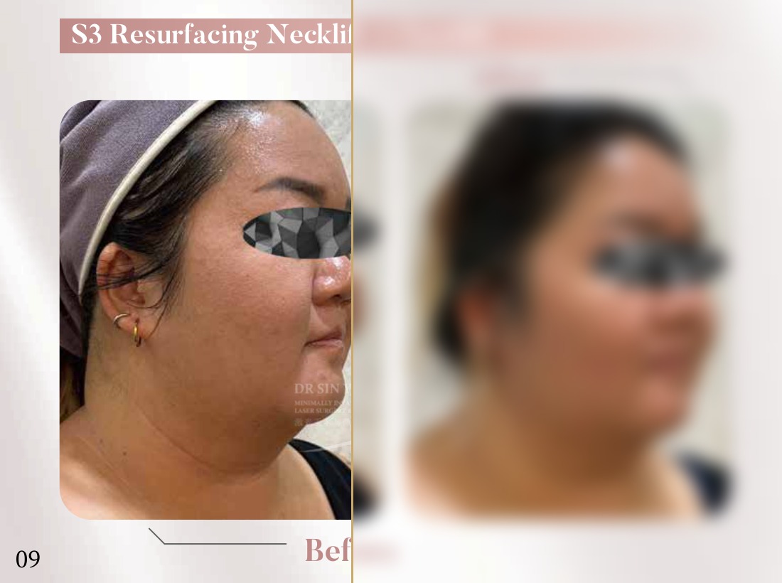 S3 Resurfacing Lift Laser — Necklift + Facelift