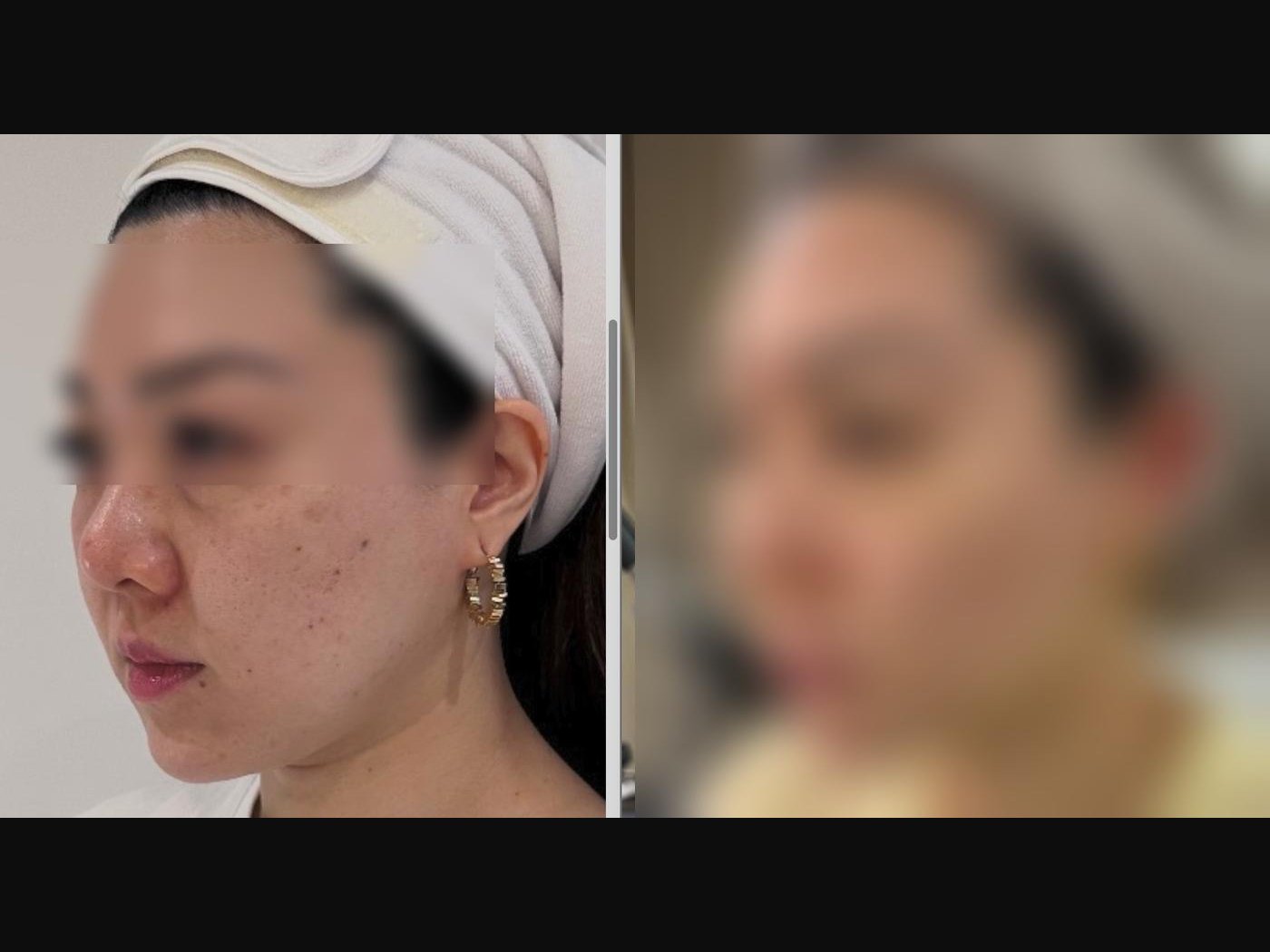 VF Facelift - Highlighting Jawline Definition