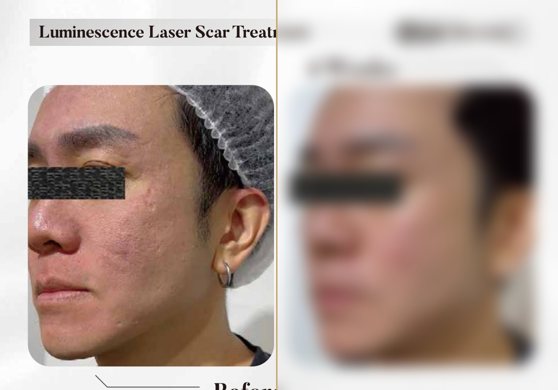 Luminescence Laser — Scar Treatment, 4 Weeks (Single Session)