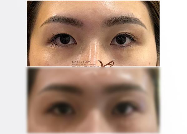 FSX Flawless Smooth Laser — Non Surgical Eye Lift for Droopy Eyelids