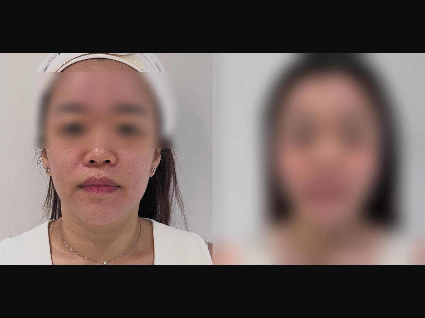 VF Facelift - Sharpens & Lifts Lower Face 6