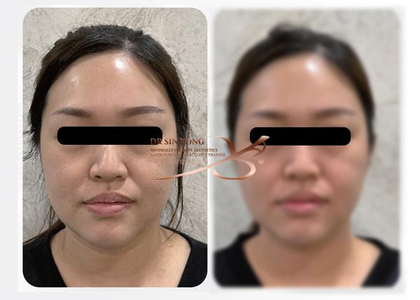 Time Freeze Laser Lift LCLR — Facelift