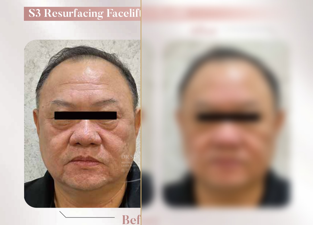 S3 Resurfacing Lift Laser — Facelift + Eyelift